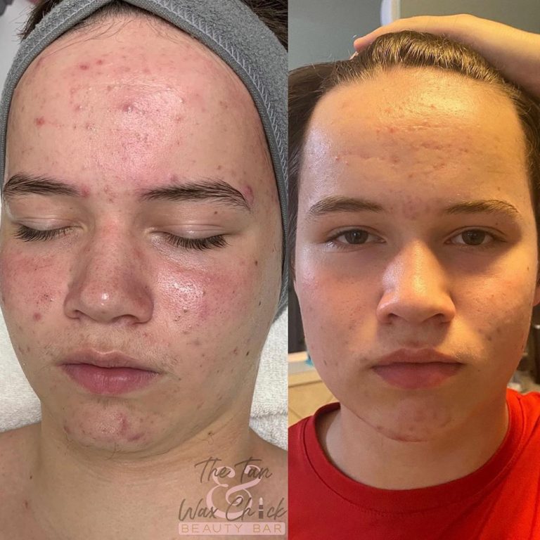 skin-care-before-and-after-05